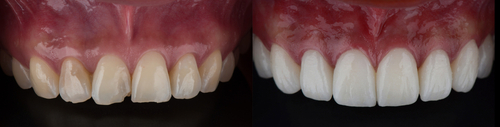 comparison of teeth before and after veneers