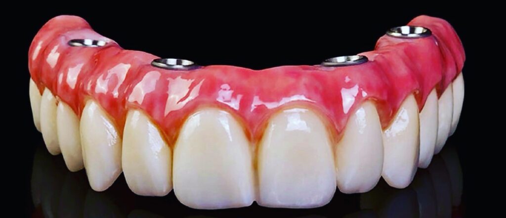 dental implants